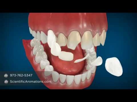 Cosmetic Dentistry Procedures - Dental Animation