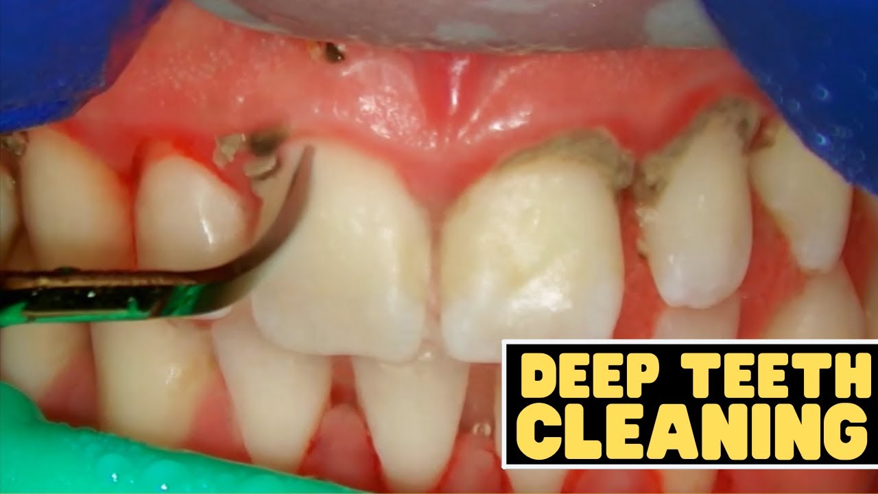 Teeth Cleaning vs Deep Cleaning | Dentist Reviews How Teeth Are Cleaned!