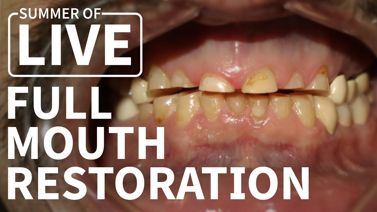 Full Mouth Dental Restoration - LIVE Treatment