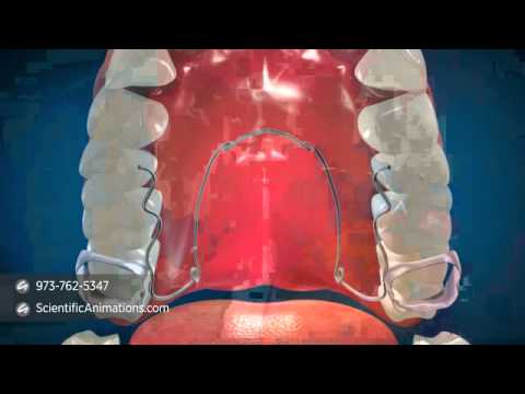 Quad Helix - Dental Procedures