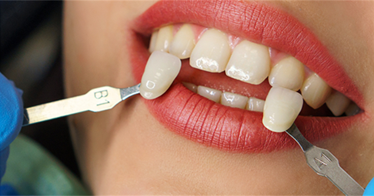 About tooth whitening | Oral Health Foundation