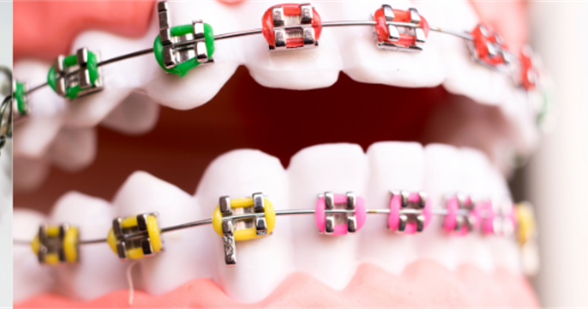 The basics of orthodontics | Oral Health Foundation