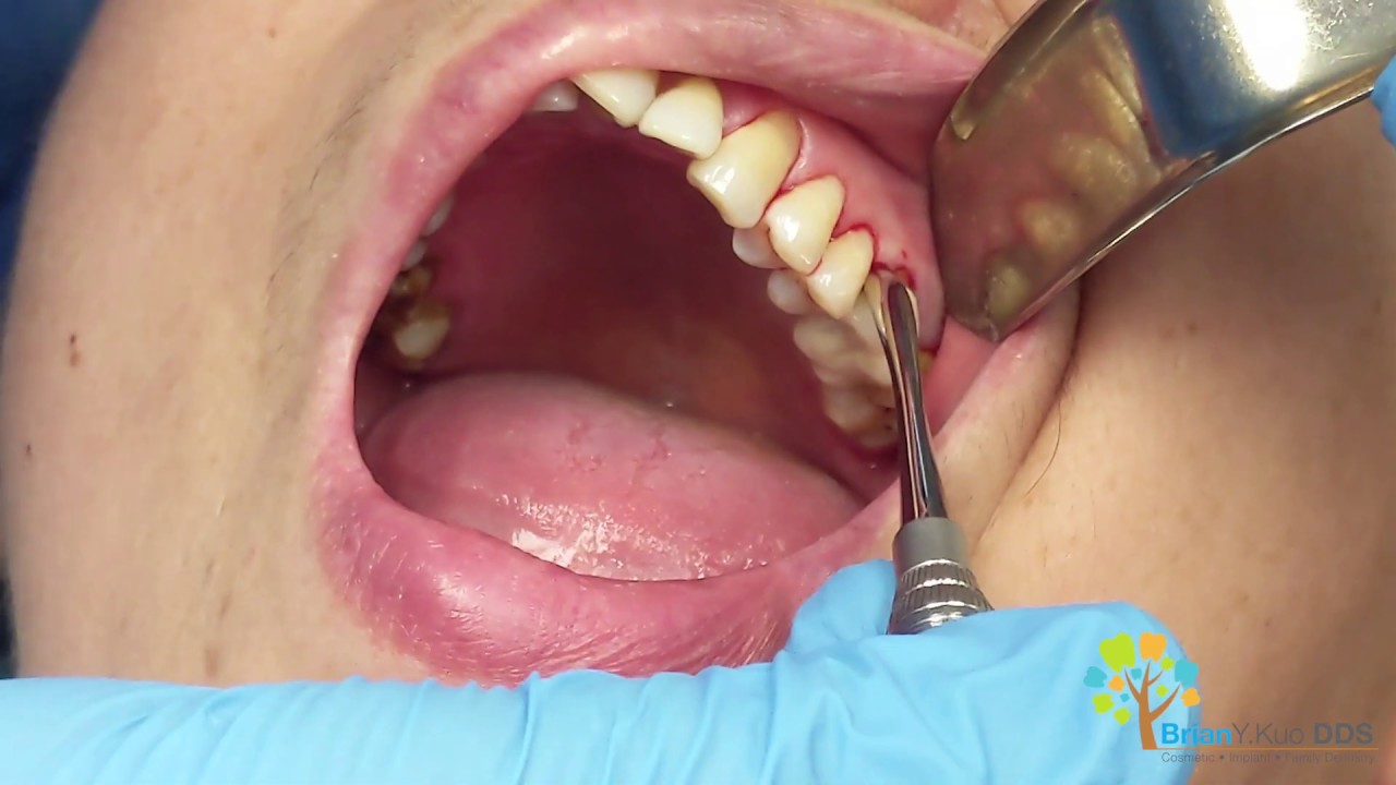 Surgical Tooth Extraction [WARNING] Extreme Decay Beneath Crown