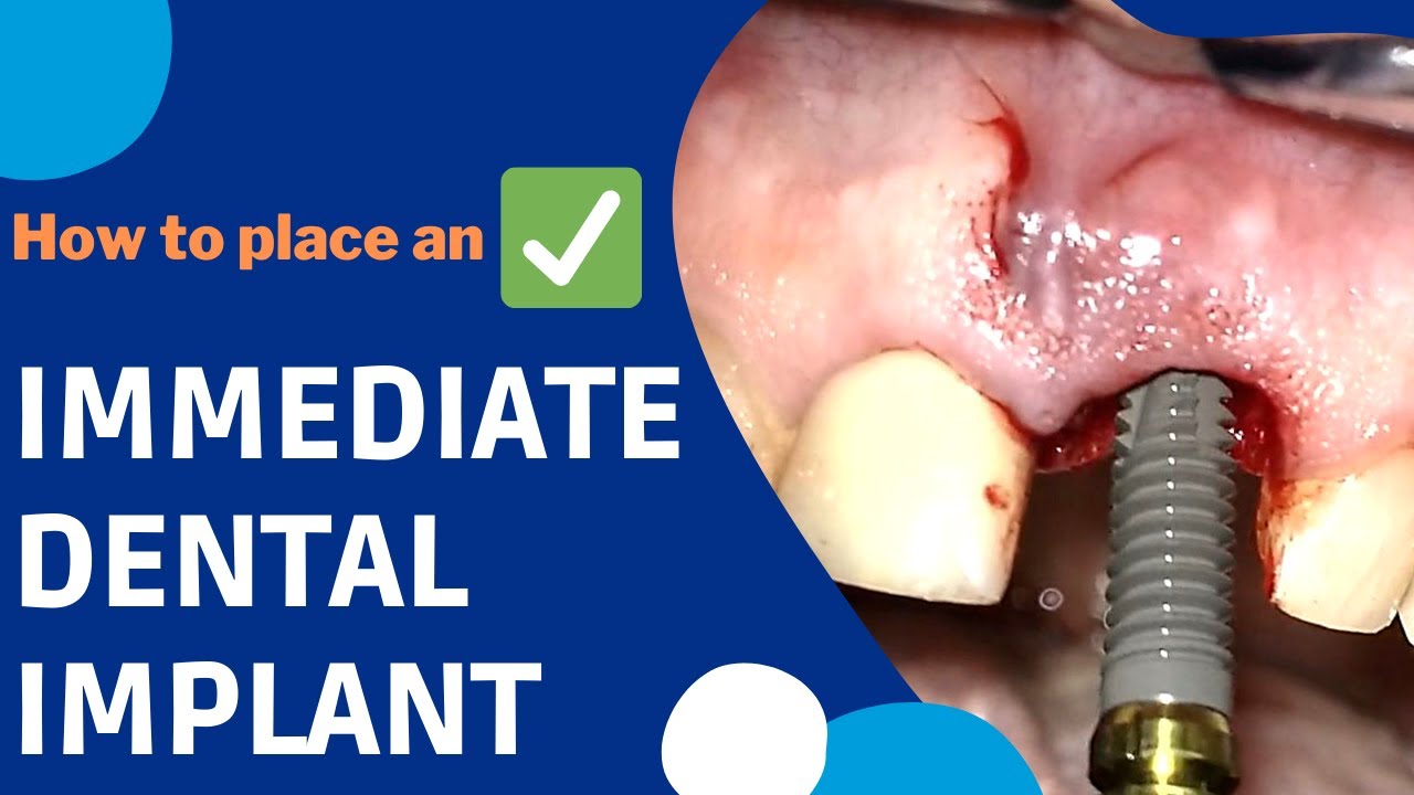 How is an immediate dental implant surgery done? #implants