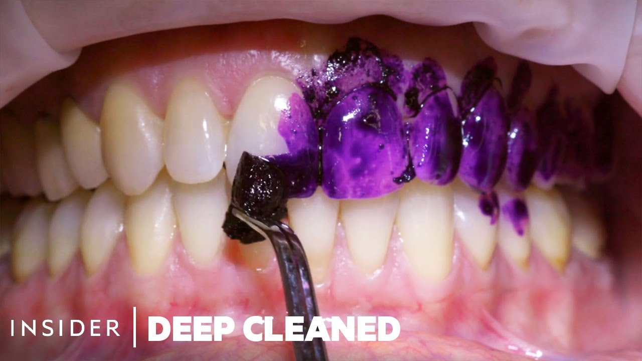How Teeth Are Professionally Deep Cleaned | Deep Cleaned