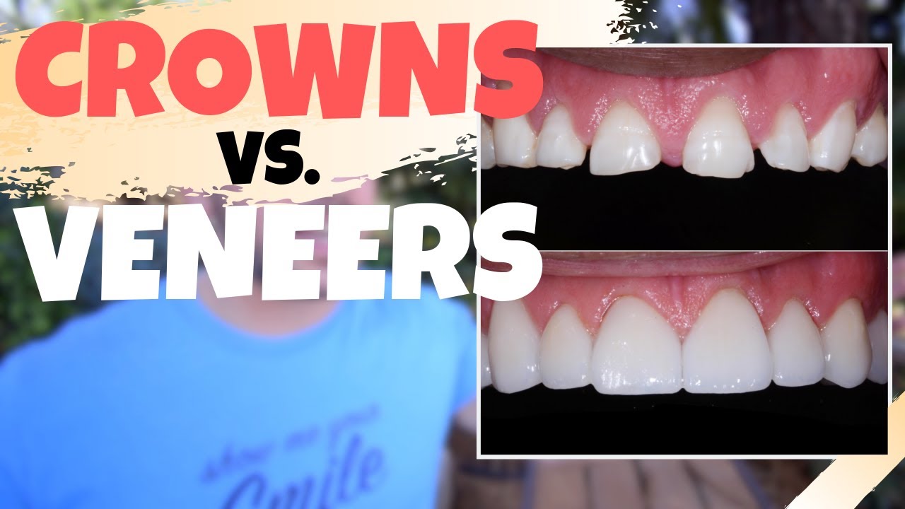 Dental CROWNS vs. Porcelain VENEERS | Is the Dental Veneers Procedure Worth It?!?