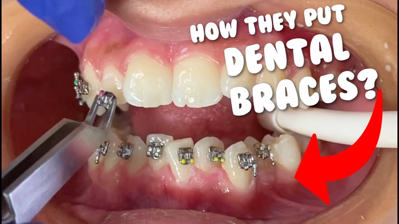 How they put braces - Dental Braces Tooth Time Family Dentistry New Braunfels