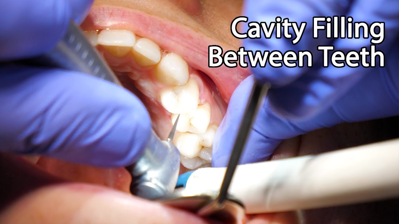 Dentist Filling A Cavity Between Teeth
