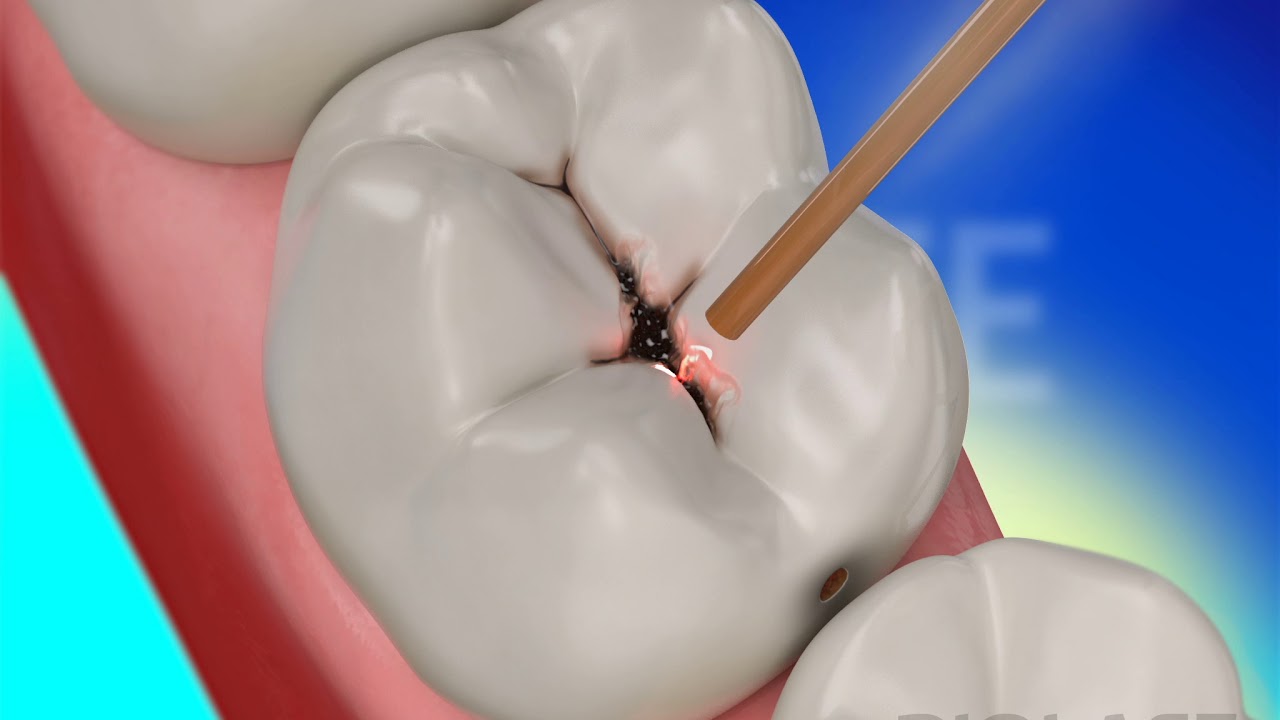Dental Restoration with Waterlase Laser Dentistry - BIOLASE