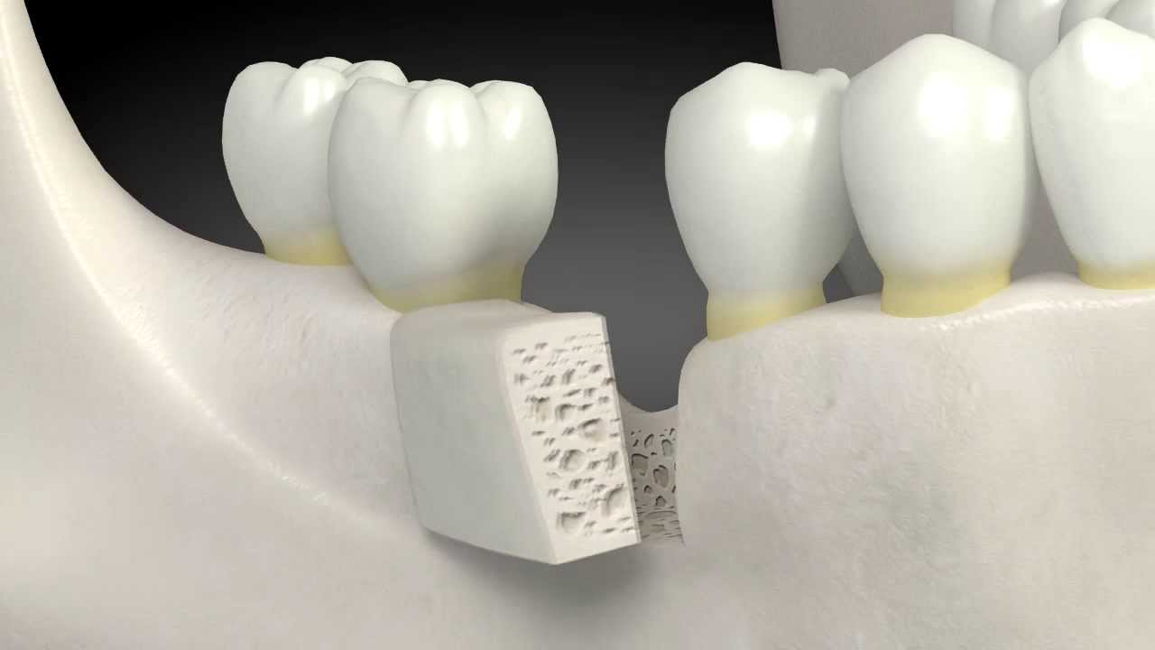 What is a dental bone graft?