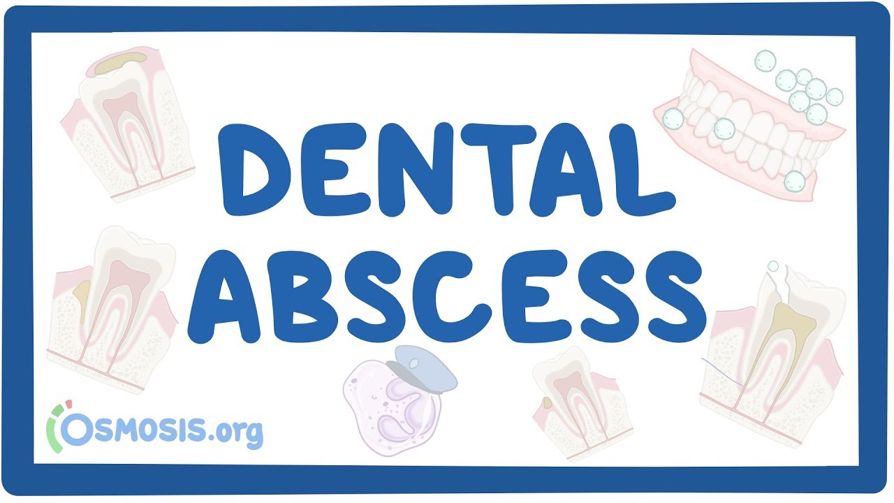 Dental abscess - causes, symptoms, diagnosis, treatment, pathology