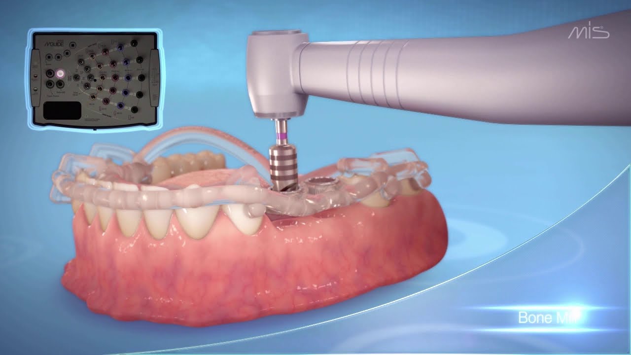 Dental implants: Bondbone surgery, oral treatments, implants (3d animation)