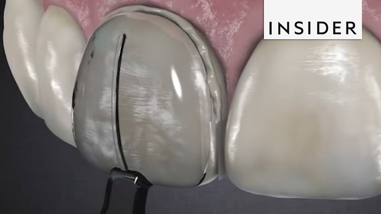 Dentist Creates New Type of Veneers