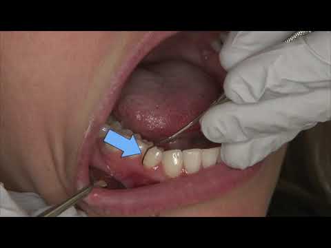 ODU 11/12 Explorer | Dental Hygiene