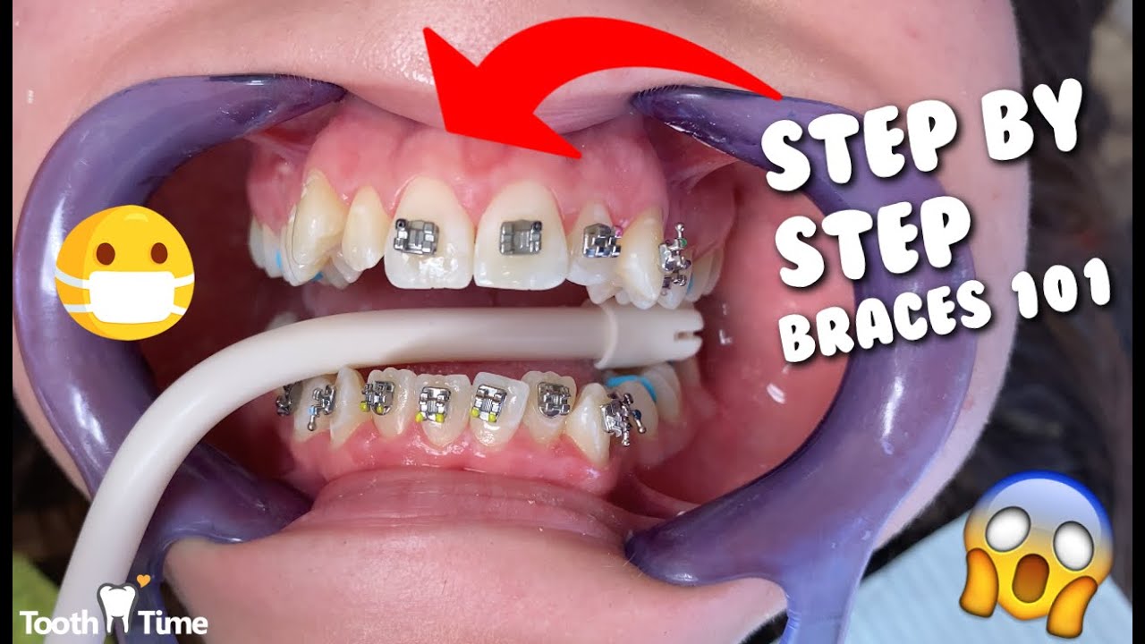 Dental Braces - Step by Step - Tooth Time Family Dentistry New Braunfels