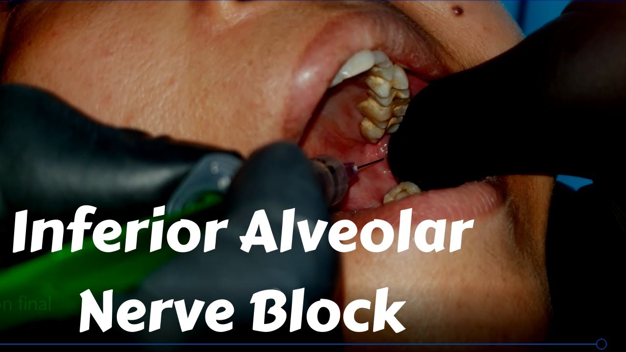 Inferior Alveolar nerve Block Injection in dentistry- Landmark & Technique in Dental Teeth Surgery