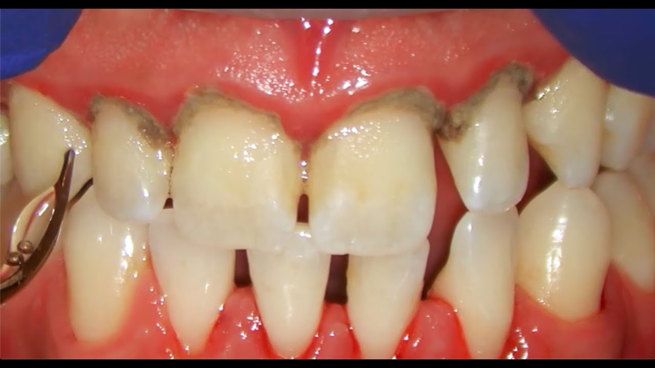 Teeth Cleaning {Satisfying} #shorts
