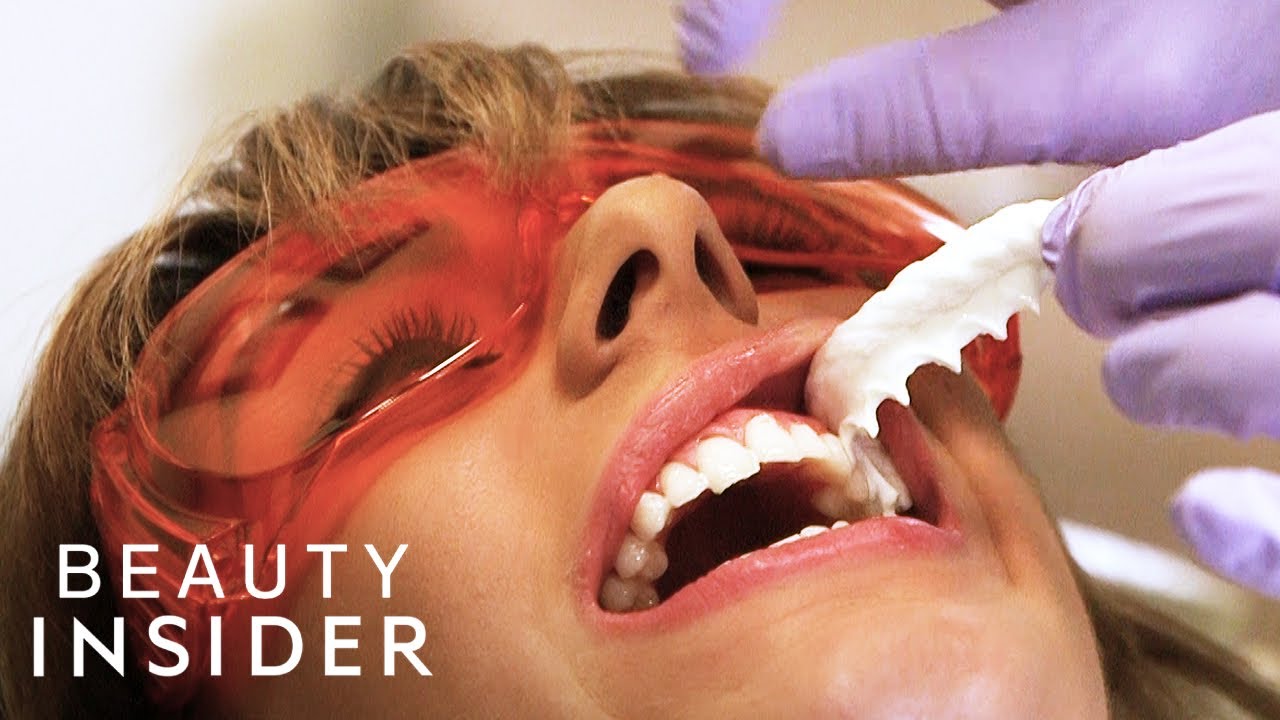The Fastest Way Dentists Whiten Teeth | Beauty Explorers