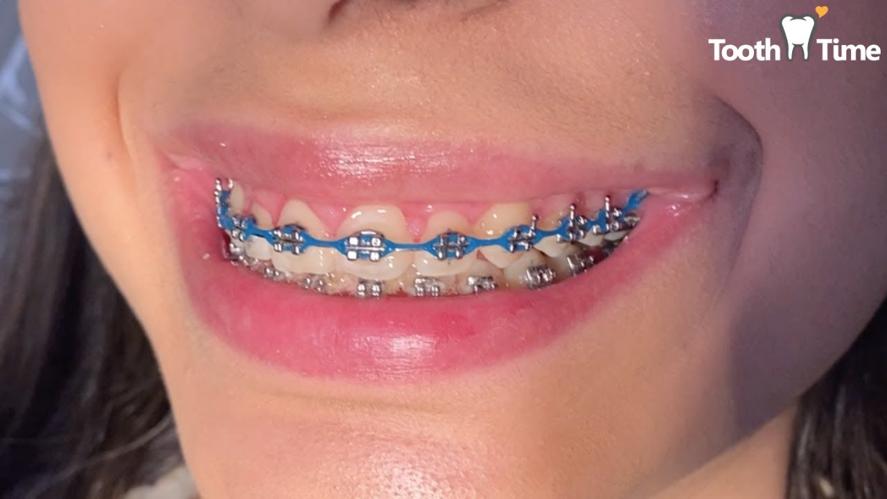 Braces permanent retainer - how do they put it - Tooth Time Family Dentistry New Braunfels
