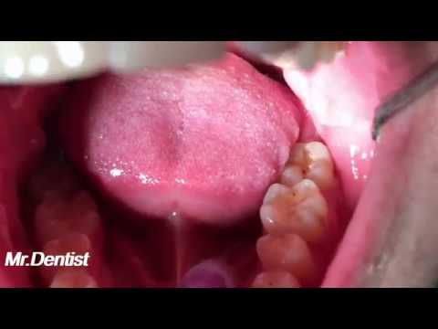 Tooth Filling Procedure - [COMPOSITE MATERIALS]