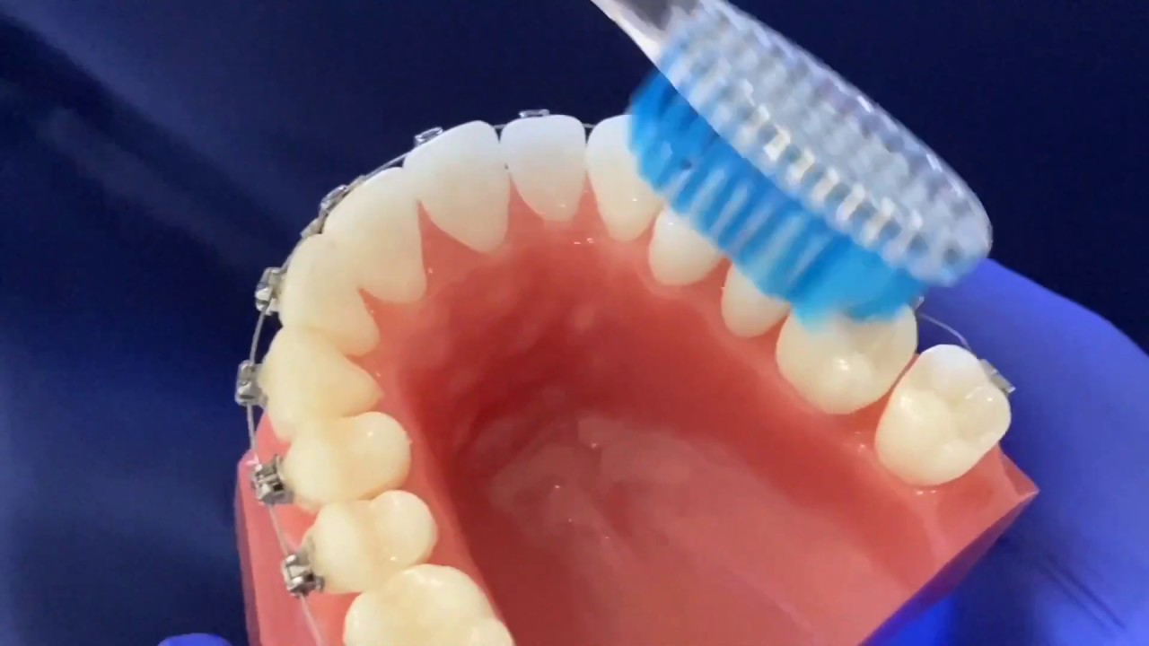 Oral Hygiene Instructions for Braces | Home Care
