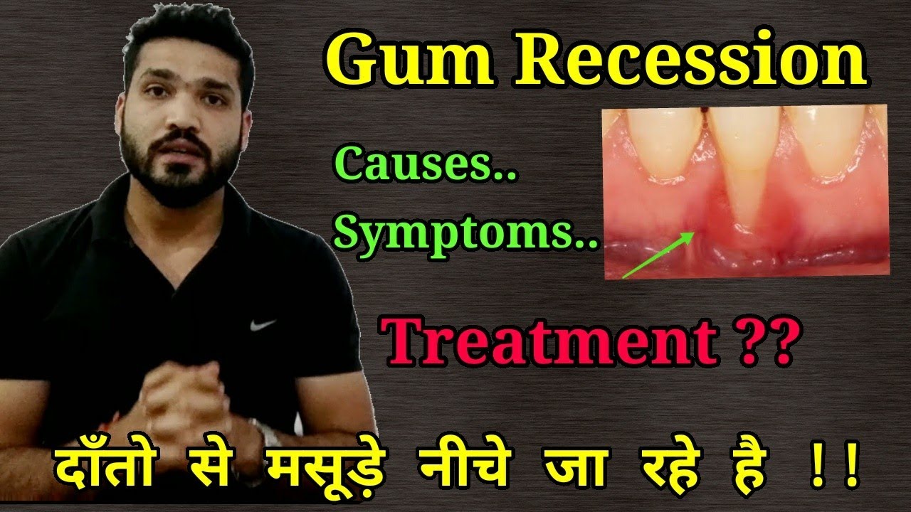 Gum recession, Causes, symptoms, treatment | How to identify receeding gums?