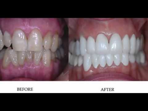Patient Photo Gallery before and after dental procedures by Dr. David Mazza.