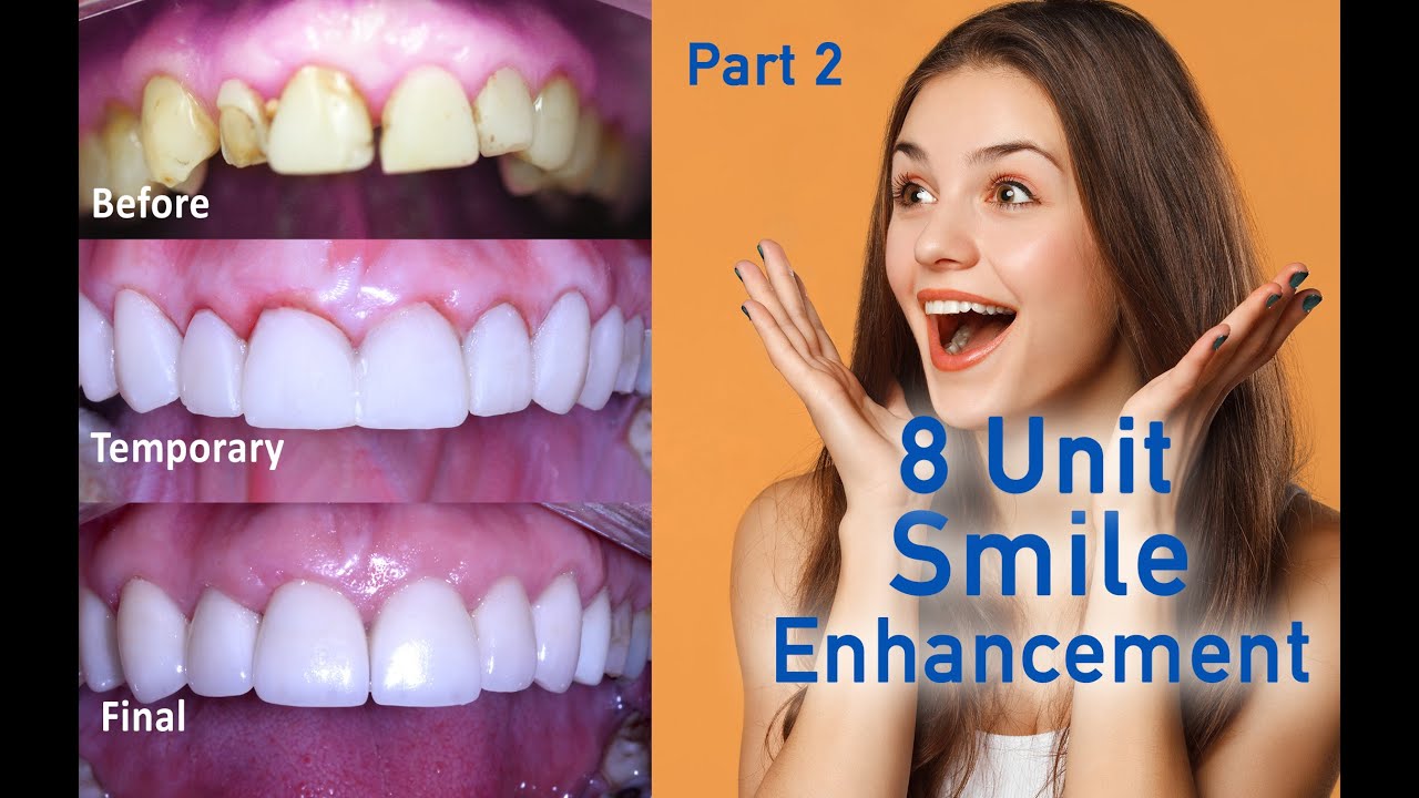 Transform your Smile with Dental Porcelain Veneers - Live Cosmetic Dental Procedure - Part 2