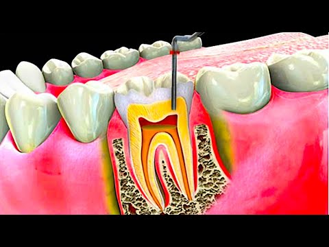 What is a Root Canal? (Root Canal Procedure Step by Step)