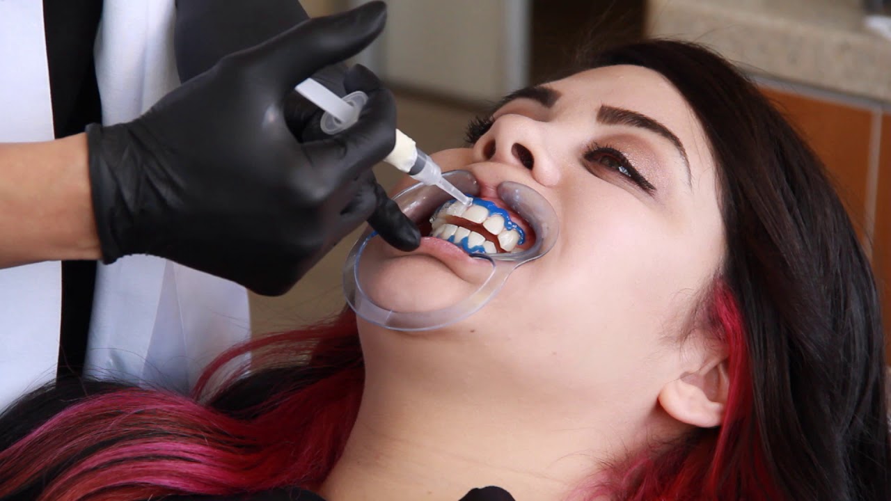 Teeth Whitening Bleaching Procedure at Glo Modern Dentistry