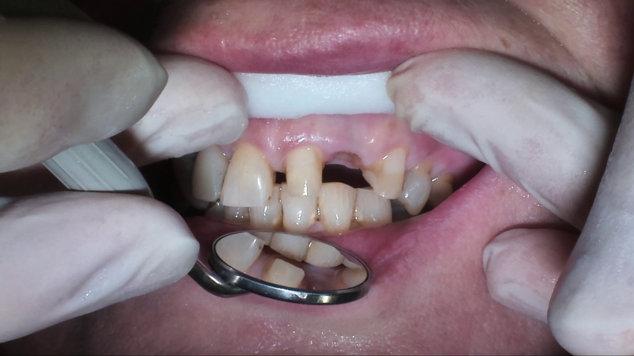 Dental video: dd21-23 bridge preparation
