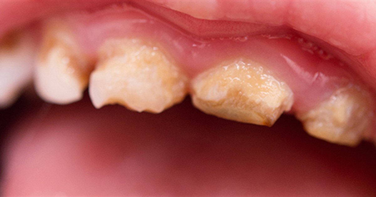 New statistics on childhood tooth decay suggest concerning lack of progress