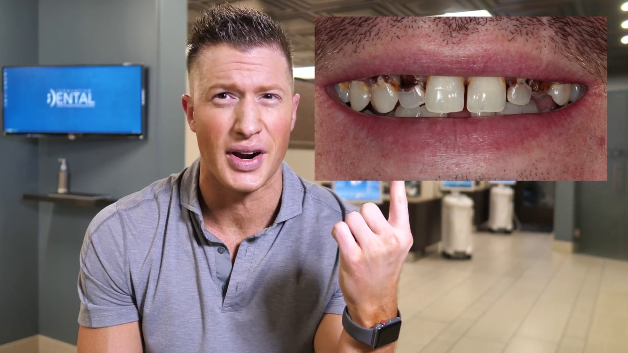 Dentist says DO NOT CROWN YOUR TEETH! - Proves it with a Clinical example!