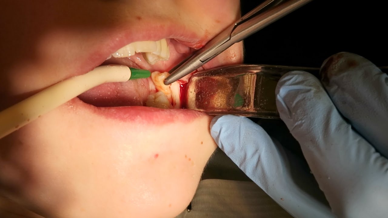 Surgical Extraction Of Wisdom Tooth l Dr. Abdul Dalghous | Yorkshire Dental Suite