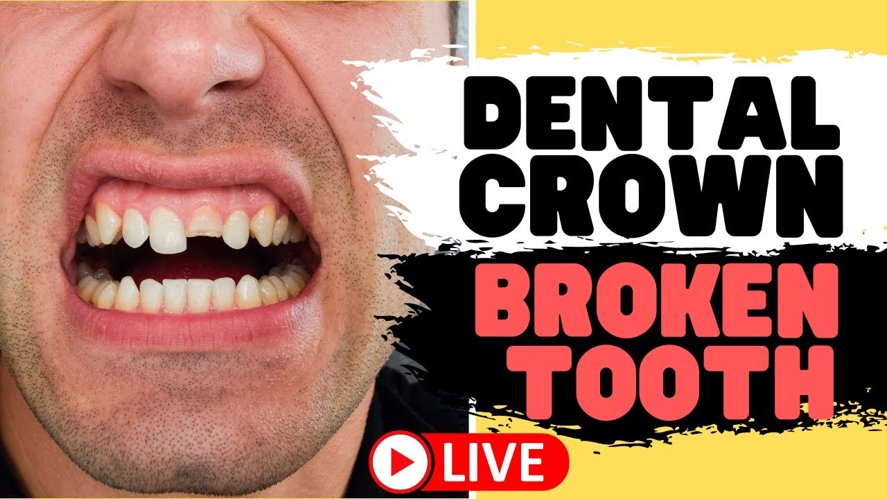 Tooth Crown Procedure | Front Tooth Crowns for Broken Teeth (LIVE)