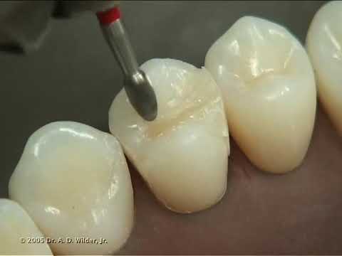 Class II Composite Preparation & Restoration | Operative Dentistry
