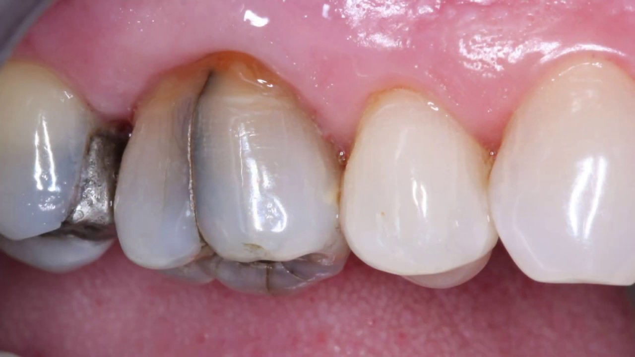 V1904 Reliable, Simple Treatment of Cracked Teeth