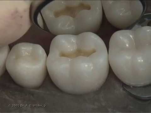 Class I Composite Preparation & Restoration | Operative Dentistry