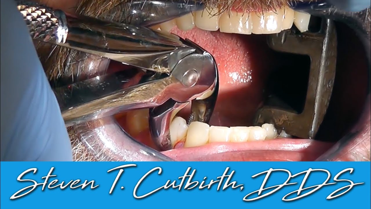 Easy Tooth Extraction - Dental Minute with Steven T.  Cutbirth, DDS