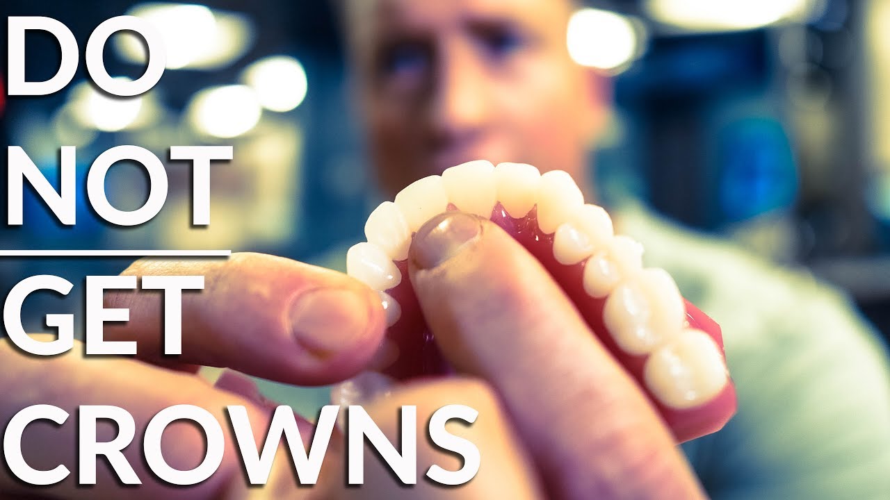 Do NOT crown your teeth! - Must watch before dental work!