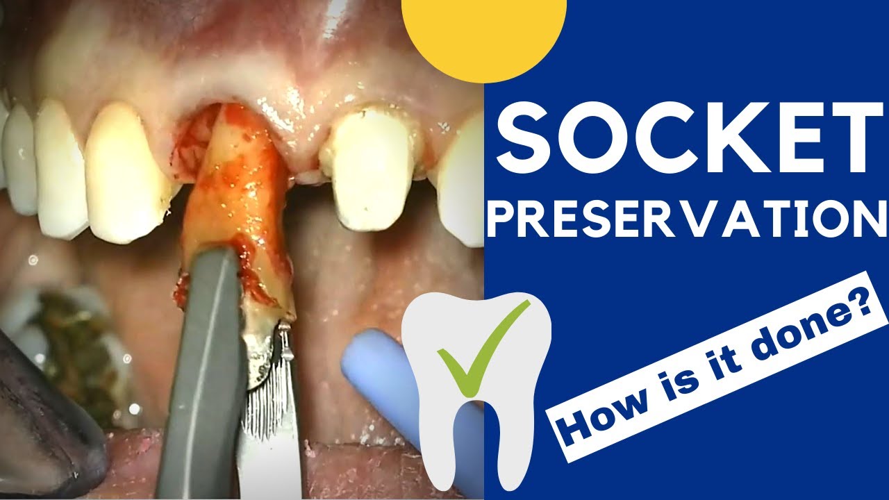 Tooth extraction and Socket preservation - How is it done?