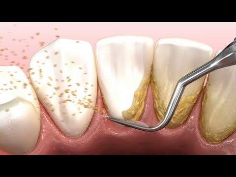 Dental scaling teeth animation