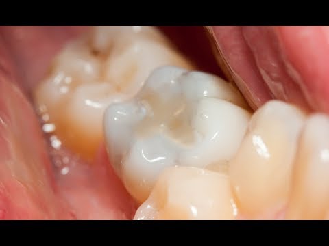 Composite Dental Filling