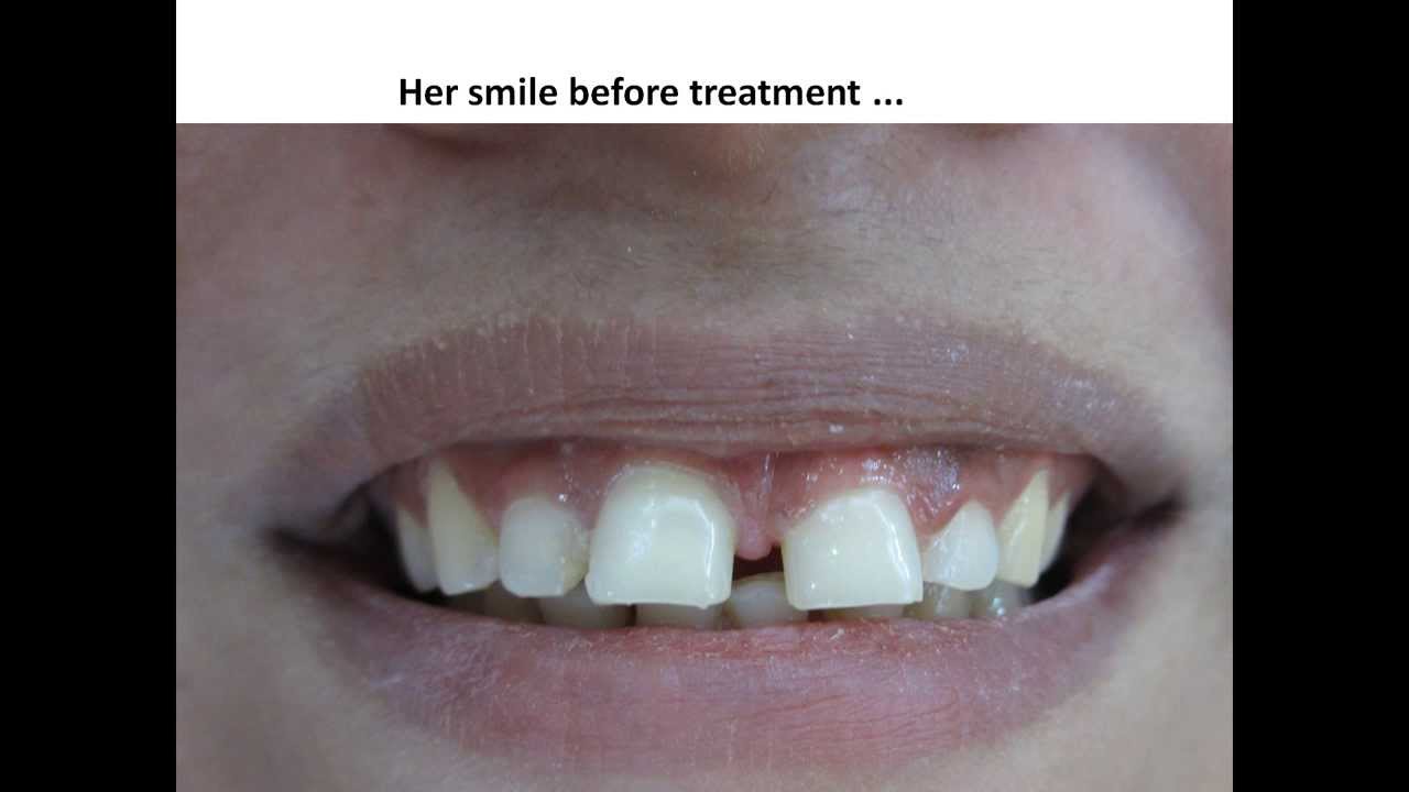 Complete Smile Makeover Case Done at Best Dental Clinic in India
