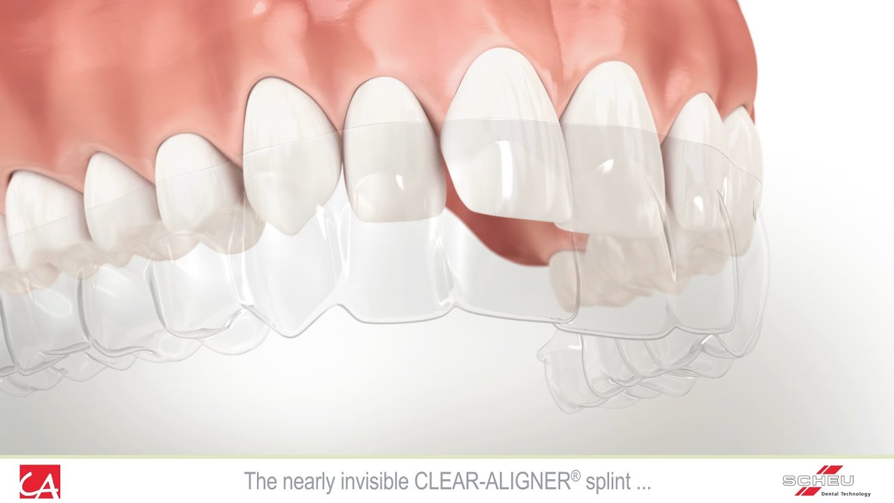 Treatment of Malocclusion Teeth with Invisible Splint
