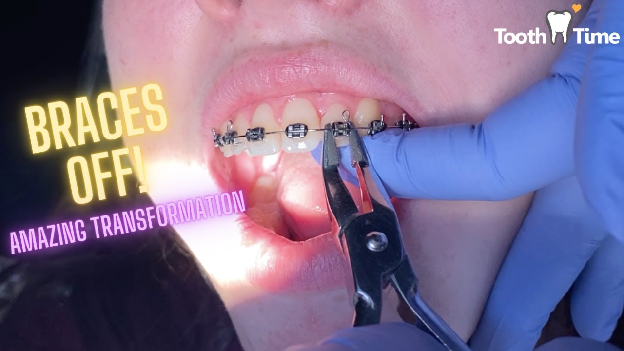 Braces Off - Amazing Transformation - Tooth Time Family Dentistry New Braunfels