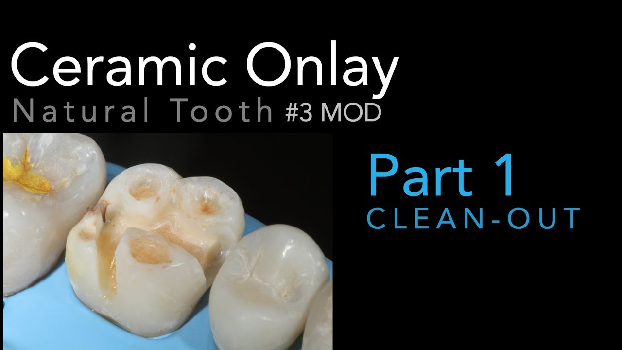 Ceramic Onlay Part 1 (Clean-out)