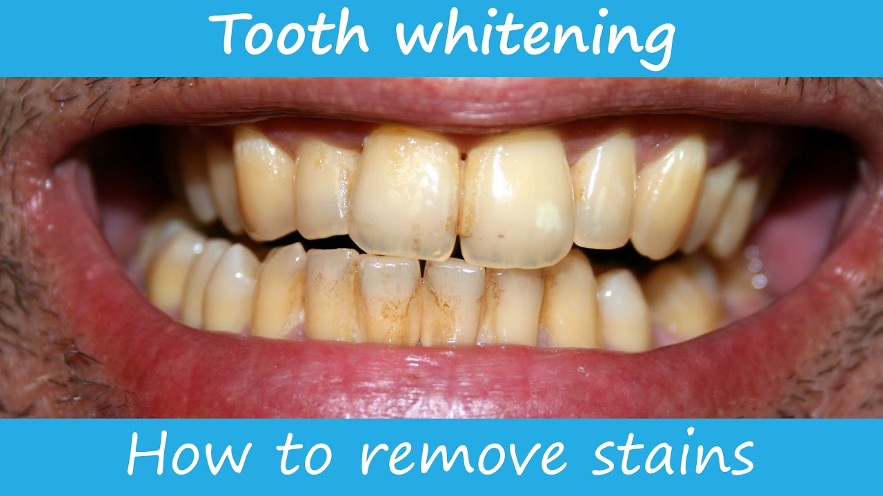 How to remove stains from the teeth