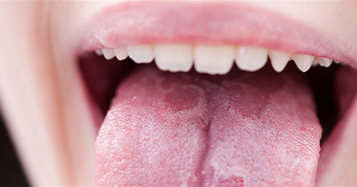 Geographic tongue - Oral Health Foundation
