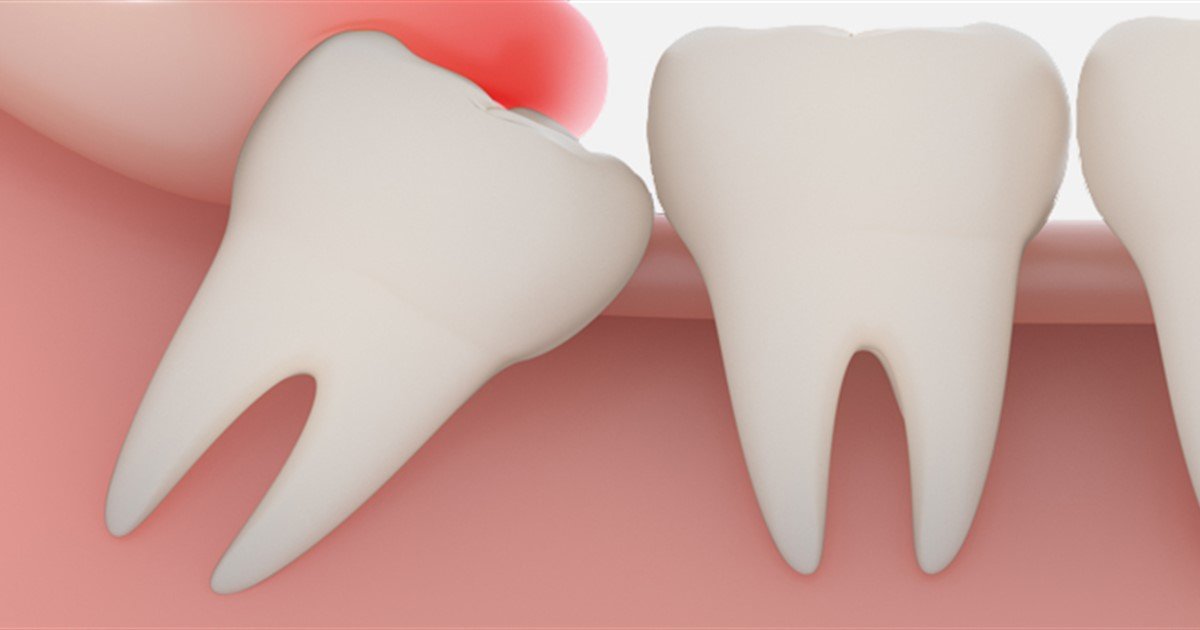 Wisdom teeth - Oral Health Foundation